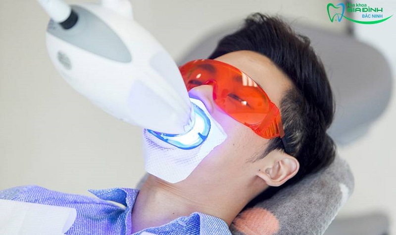 Hỏi đáp nhanh: Khi nào nên tẩy và không nên tẩy răng nha khoa? 4 Công nghệ tẩy răng nha khoa Laser