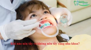 Khi nào nên tẩy và không nên tẩy răng nha khoa?