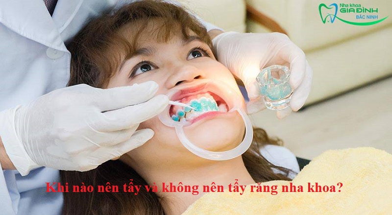 Hỏi đáp nhanh: Khi nào nên tẩy và không nên tẩy răng nha khoa? 1 Khi nào nên tẩy và không nên tẩy răng nha khoa?