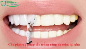Các phương pháp tẩy trắng răng an toàn tại nhà