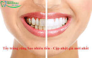 Tẩy trắng răng bao nhiêu tiền - Cập nhật giá mới nhất 2023