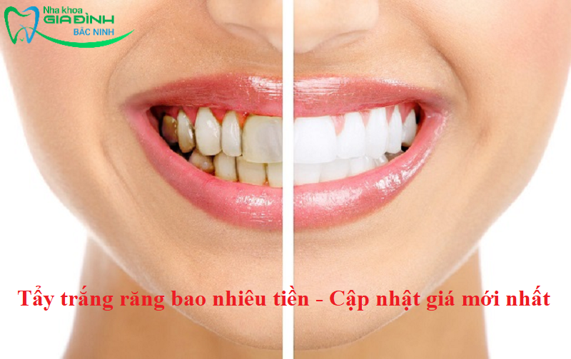 Tẩy trắng răng bao nhiêu tiền - Cập nhật giá mới nhất 2024 1 Tẩy trắng răng bao nhiêu tiền - Cập nhật giá mới nhất 2023
