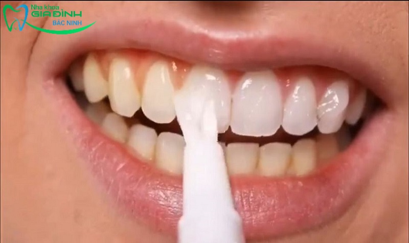 Tẩy trắng răng có hại không, có ảnh hưởng đến sức khỏe? 2 Bạn có nên thực hiện tẩy trắng răng tại nhà hay không?
