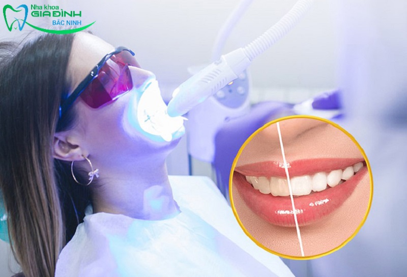 Tẩy trắng răng có hại không, có ảnh hưởng đến sức khỏe? 3 Trường hợp không nên tẩy trắng răng là gì?