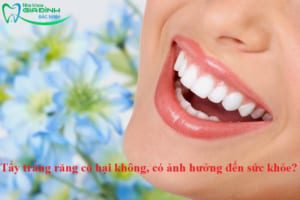 Tẩy trắng răng có hại không, có ảnh hưởng đến sức khỏe?