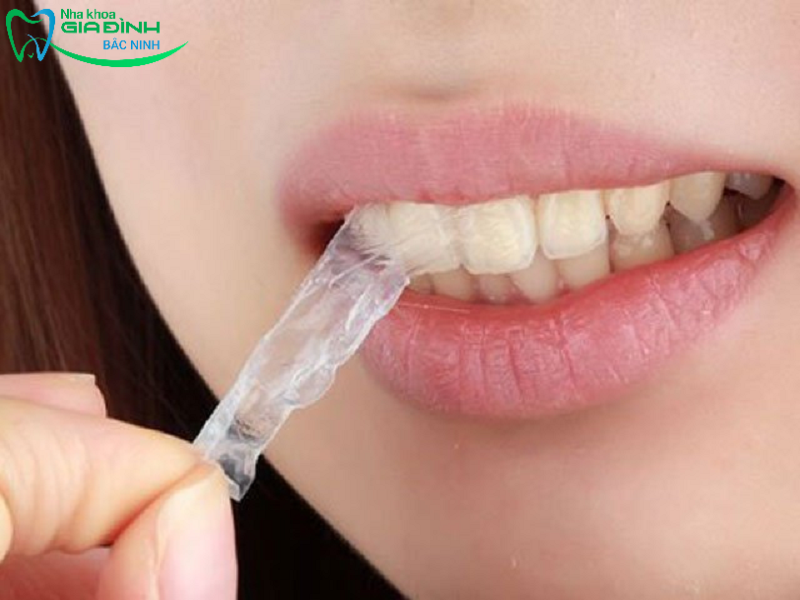 Tẩy trắng răng có tốt không? Phương pháp tẩy trắng răng tốt 3 Tẩy trăng răng bằng miếng dán trắng răng