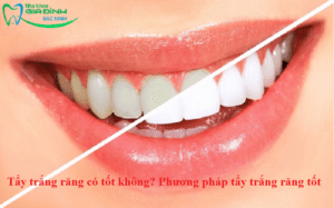 Tẩy trắng răng có tốt không? Phương pháp tẩy trắng răng tốt