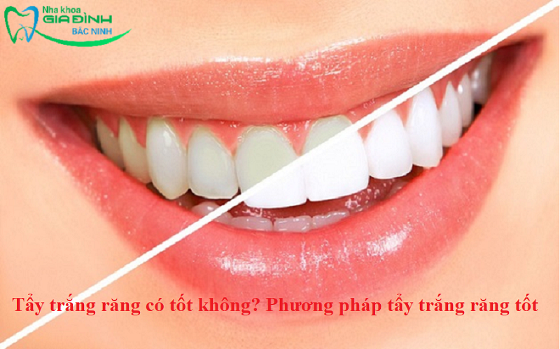 Tẩy trắng răng có tốt không? Phương pháp tẩy trắng răng tốt 1 Tẩy trắng răng có tốt không? Phương pháp tẩy trắng răng tốt