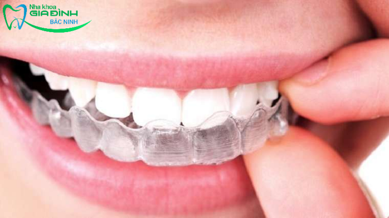 8 cách tẩy trắng răng tại nhà an toàn, hiệu quả 4 Sử dụng công cụ nha khoa để làm trắng răng