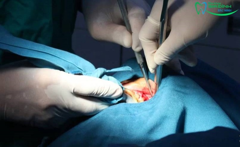 Trồng răng all on 6 như thế nào? Cập nhật giá chi tiết 3 Khám phá quy trình trồng răng implant All on 6 chuẩn