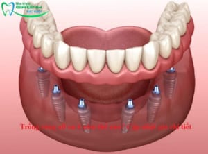 Trồng răng all on 6 như thế nào? Cập nhật giá chi tiết