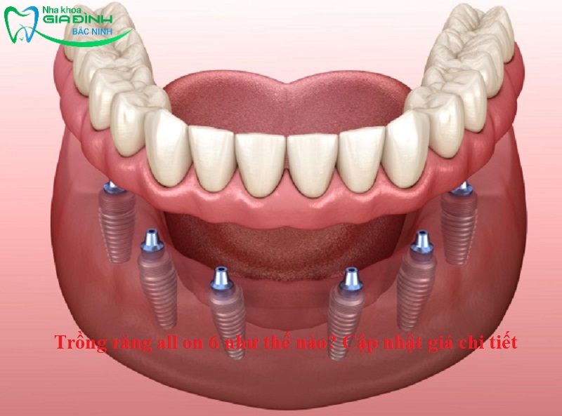 Trồng răng all on 6 như thế nào? Cập nhật giá chi tiết 1 Trồng răng all on 6 như thế nào? Cập nhật giá chi tiết