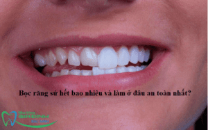 avt boc rang su het bao nhieu