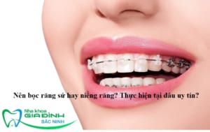 avt nen boc rang su hay nieng rang