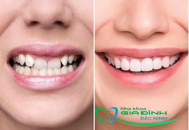 Có nên bọc răng sứ cho hàm hô? Địa chỉ nào chất lượng? 2 Bọc răng sứ cho hàm hô nhanh chóng và thẩm mỹ.