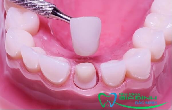 Có nên bọc răng sứ cho hàm hô? Địa chỉ nào chất lượng? 1 Bọc răng sứ cho hàm bị hô được nhiều người lựa chọn