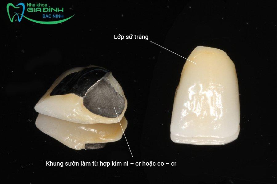 Giá bọc răng sứ kim loại có đắt không, bao nhiêu tiền? 2 Răng sứ kim loại thường