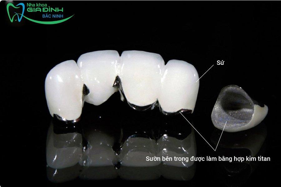 Giá bọc răng sứ kim loại có đắt không, bao nhiêu tiền? 3 Răng sứ kim loại Titan