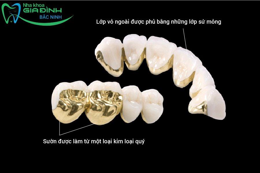 Giá bọc răng sứ kim loại có đắt không, bao nhiêu tiền? 4 Răng sứ kim loại quý