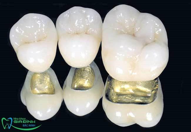 Giá bọc răng sứ kim loại có đắt không, bao nhiêu tiền? 5 Giá bọc răng sứ kim loại phụ thuộc nhiều yếu tố