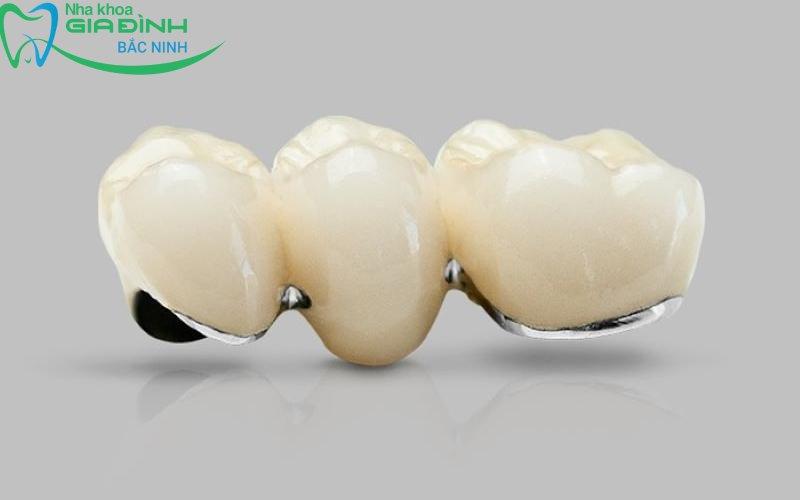 Giá bọc răng sứ kim loại có đắt không, bao nhiêu tiền? 1 gia boc rang su kim loai