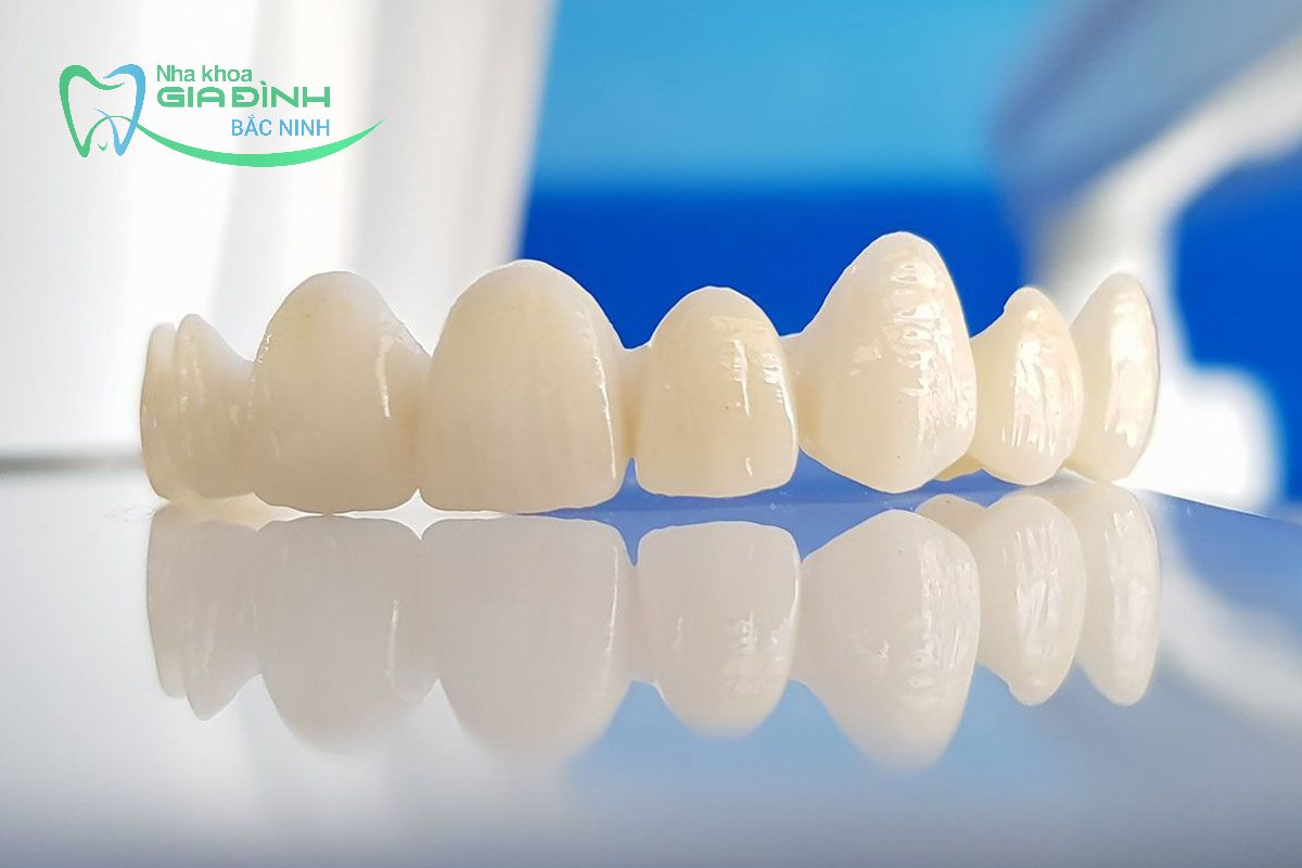 Giá bọc răng sứ tại Tiên Du và những yếu tố ảnh hưởng? 2 Răng toàn sứ có mức giá cao