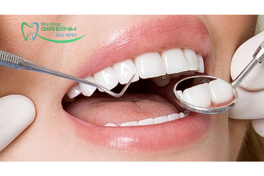 Giá bọc răng sứ tại Tiên Du và những yếu tố ảnh hưởng? 4 Mức giá bọc răng sứ tại Tiên Du phụ thuộc nhiều yếu tố