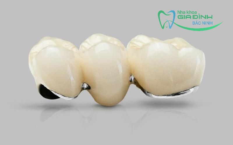 Giá bọc răng sứ tại Tiên Du và những yếu tố ảnh hưởng? 1 Giá bọc răng sứ tại Tiên Du - Răng sứ kim loại