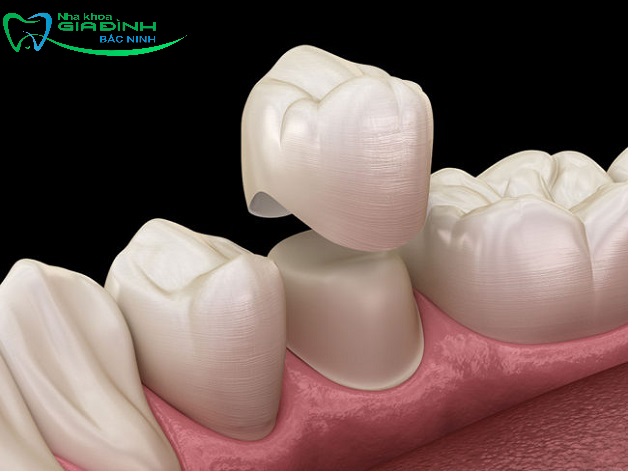 Nên bọc răng sứ hay niềng răng? Thực hiện tại đâu uy tín? 3 Bọc răng sứ cải thiện tính thẩm mỹ cho răng