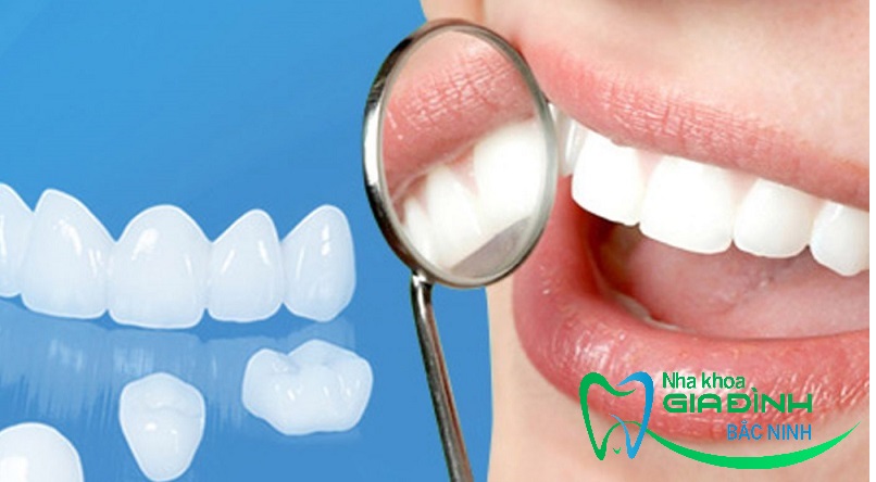 Nên bọc răng sứ hay niềng răng? Thực hiện tại đâu uy tín? 4 Thực hiện dịch vị tại Nha khoa gia đình Bắc Ninh đảm bảo uy tín