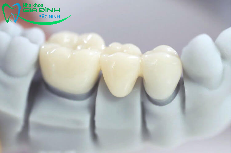 Giá bọc răng sứ tại Quế Võ mới nhất năm 2024 3 Bọc răng sứ là phương pháp nha khoa được ưa chuộng hiện nay