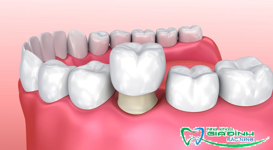 Nghệ sĩ bọc răng sứ và những chia sẻ khi thực hiện 3 Bọc răng sứ có mang lại nhiều ưu điểm