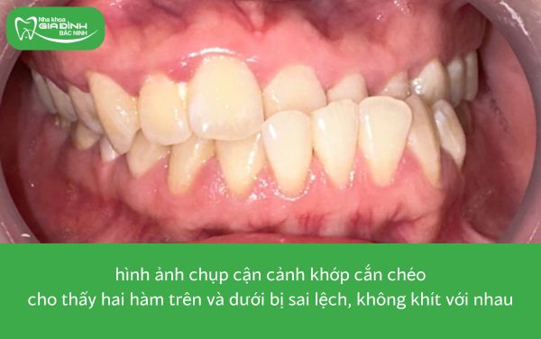 hình ảnh khớp cắn chéo thuộc 8 trường hợp nên niềng răng