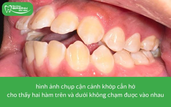 hình ảnh khớp cắn hở thuộc 8 trường hợp nên niềng răng