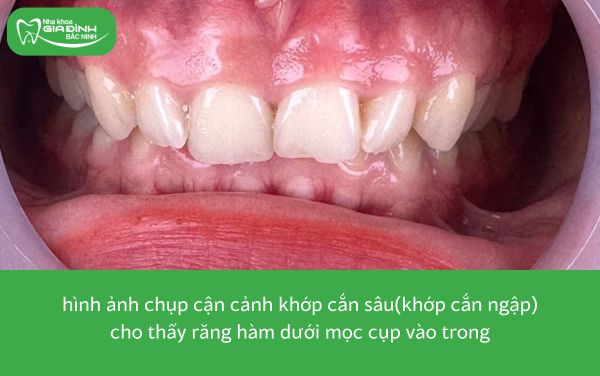 hình ảnh khớp cắn sâu(khớp cắn ngập) thuộc 8 trường hợp nên niềng răng
