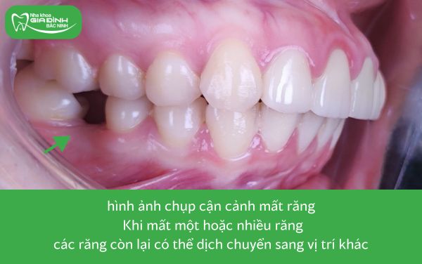 hình ảnh mất một hoặc nhiều răng thuộc 8 trường hợp nên niềng răng