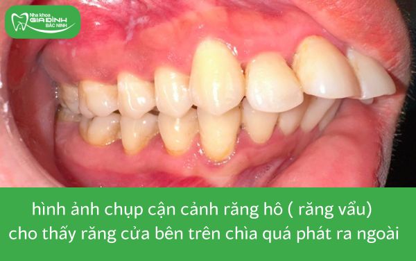 hình ảnh chụp cận cảnh răng hô (răng vẩu) thuộc 8 trường hợp nên niềng răng