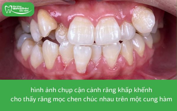 hình ảnh răng khấp khểnh thuộc 8 trường hợp nên niềng răng