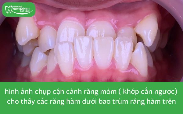 hình ảnh răng móm (khớp cắn ngược) thuộc 8 trường hợp nên niềng răng