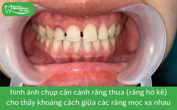 hình ảnh răng thưa(răng hở kẽ) thuộc 8 trường hợp nên niềng răng