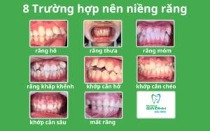 8 Trường hợp nên niềng răng có thể bạn chưa biết
