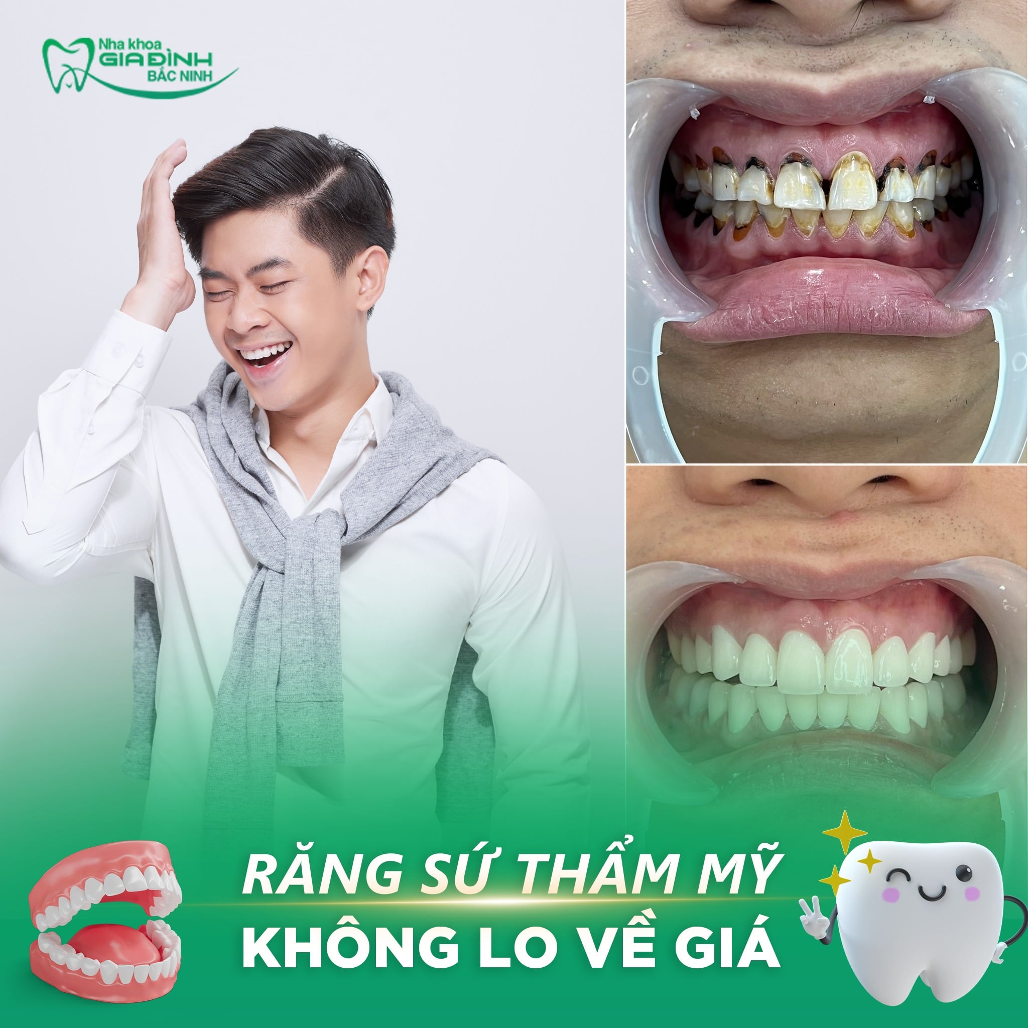 Bọc răng sứ trả góp không lãi suất Bắc Ninh 1 Bọc răng sứ trả góp không lãi suất Bắc Ninh