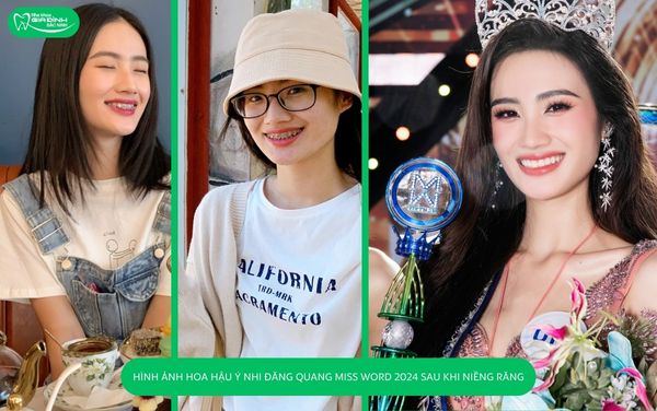 hoa hậu Ý Nhi khoe nụ cười đầy tự tin tại Miss World 2024 sau khi tháo niềng răng