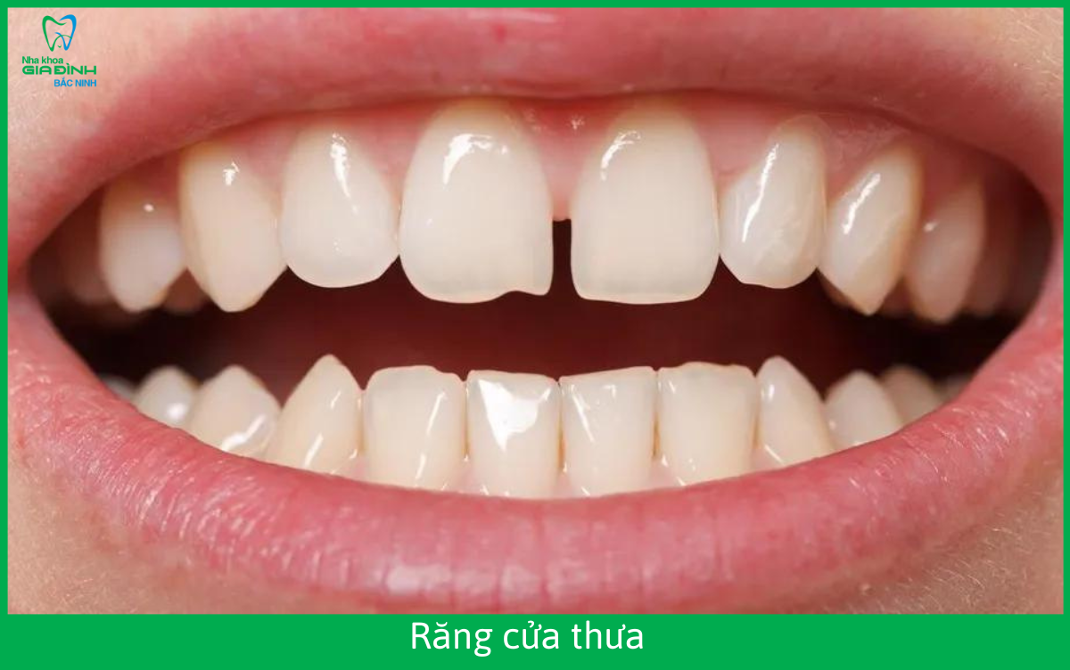 Bọc răng sứ cho răng cửa thưa