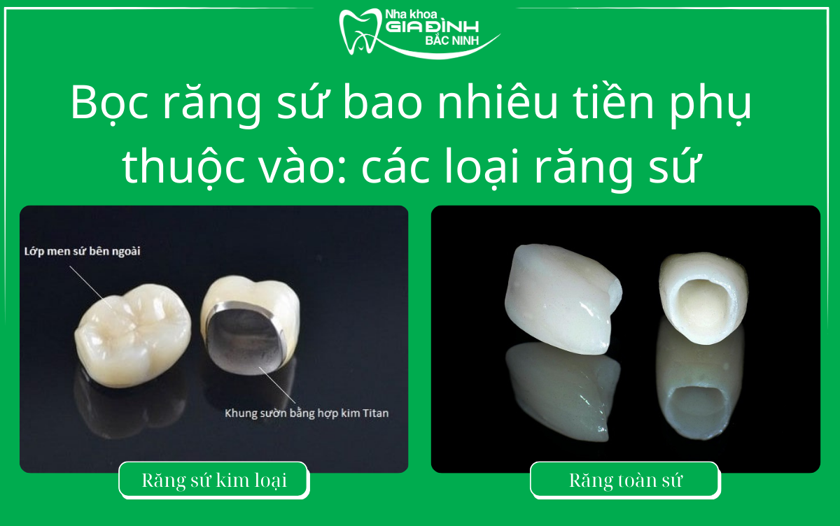 Rang su kim loai va rang toan su