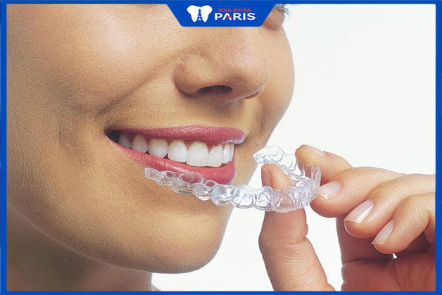 ảnh niềng răng tại Nha Khoa Paris thuộc trong Top 3 địa chỉ niềng răng uy tín chuyên sâu tại Bắc Ninh