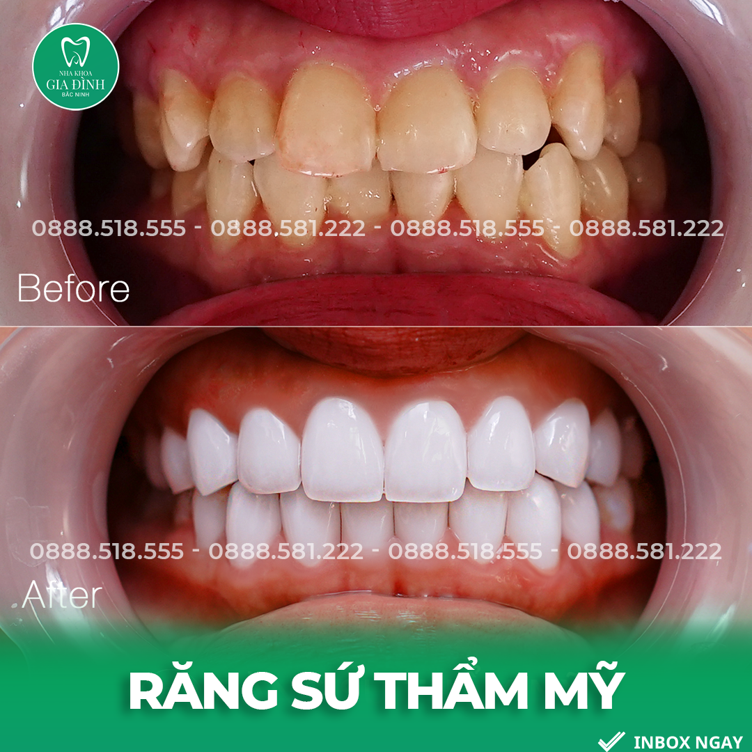 Bọc răng sứ có tốt không?Trường hợp nào nên và không nên bọc răng sứ?