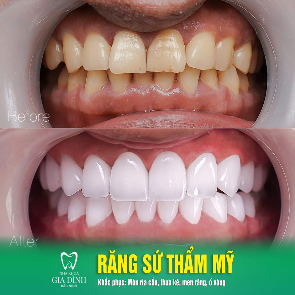 Bọc răng sứ bao nhiêu tiền? Bọc răng sứ ở đâu Bắc Ninh uy tín?