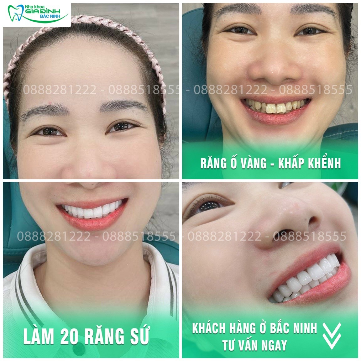 Bọc răng sứ trả góp không lãi suất Bắc Ninh 6 z5327796344325 2c562af08348139b64cfca96d4051027