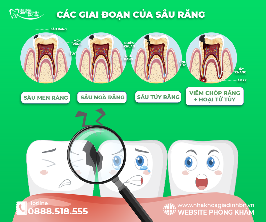 SÂU RĂNG : NGUYÊN NHÂN, DẤU HIỆU, ĐIỀU TRỊ VÀ CÁCH PHÒNG NGỪA HIỆU QUẢ